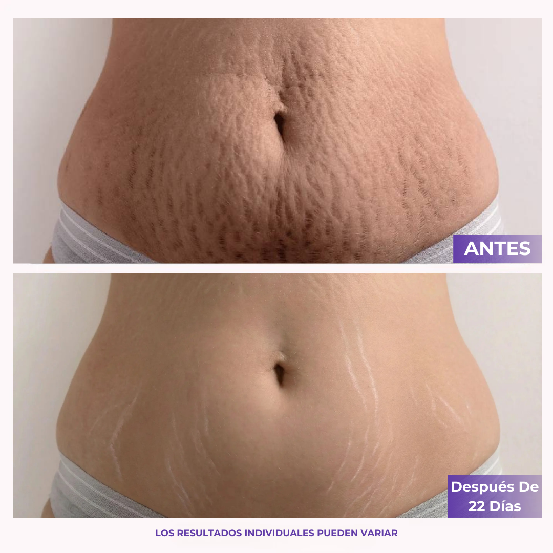 AVERA™ Crema Reafirmante y Antiestrías Para Abdomen
