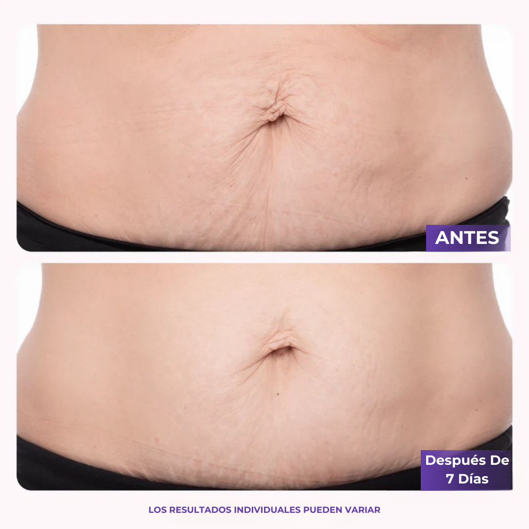 AVERA™ Crema Reafirmante y Antiestrías Para Abdomen